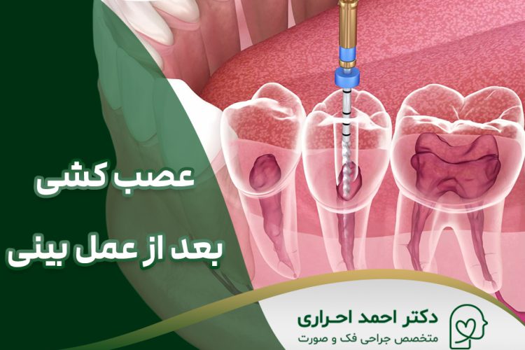 عصب کشی دندان بعد از عمل بینی
