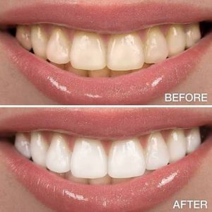 چند وقت بعد از عمل بینی میتوان به دندانپزشکی رفت؟